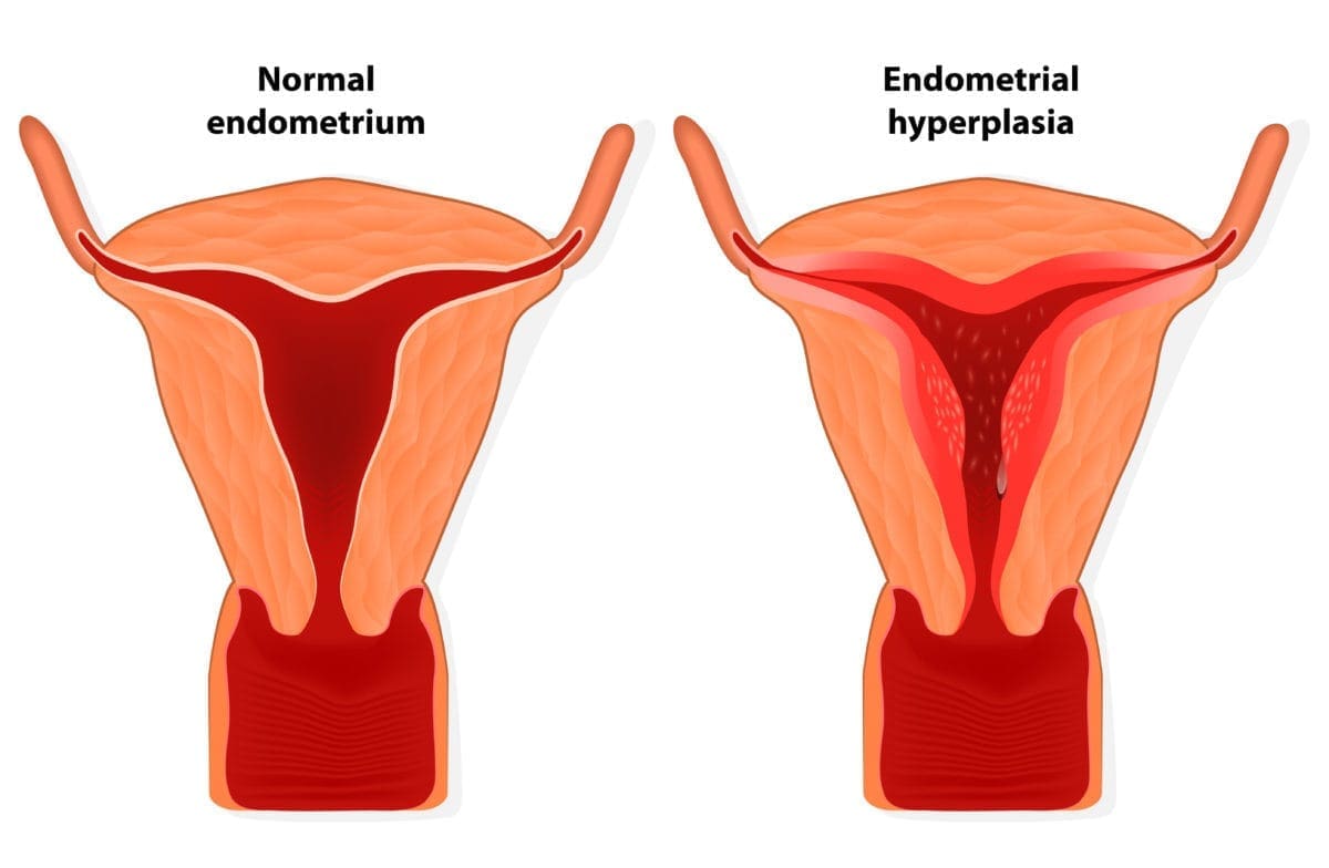 endometrial hyperplasia
