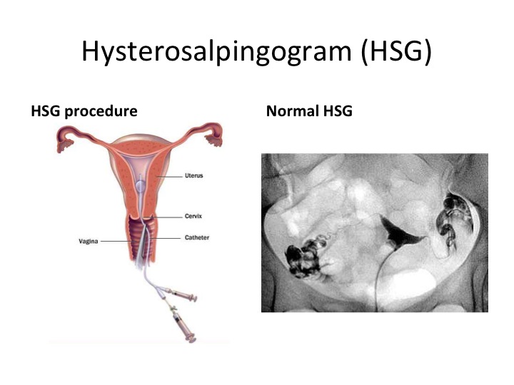 hsg