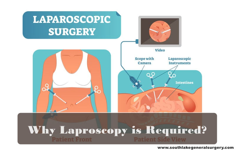 Laparoscopy