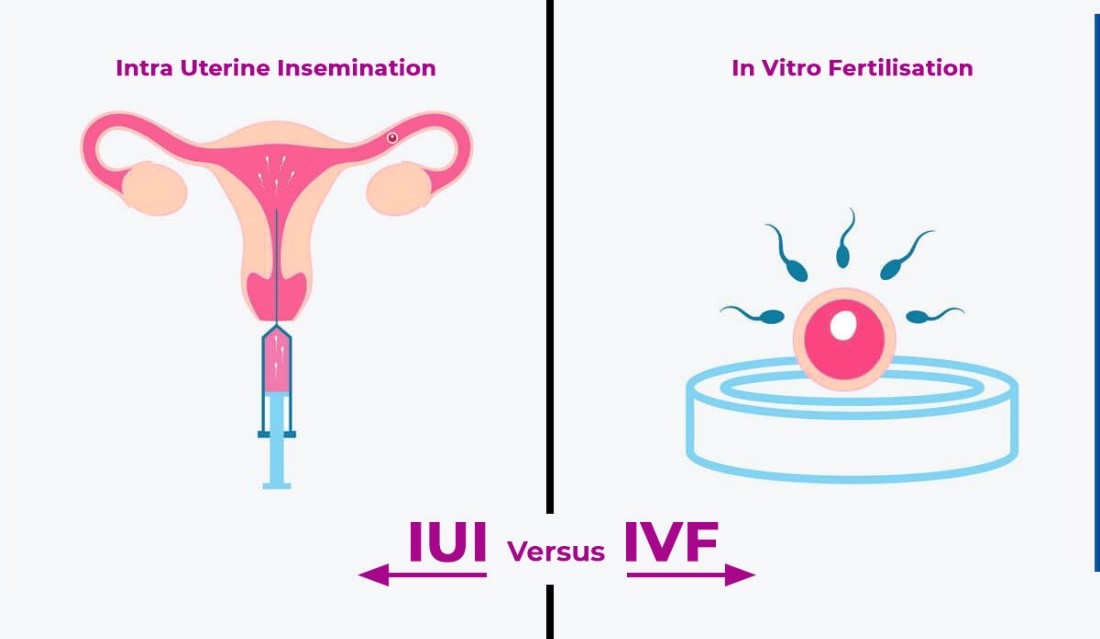 ivf iui