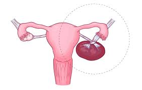 Uncovering the Urgency of Ovarian Torsion 32 ovarian torsion