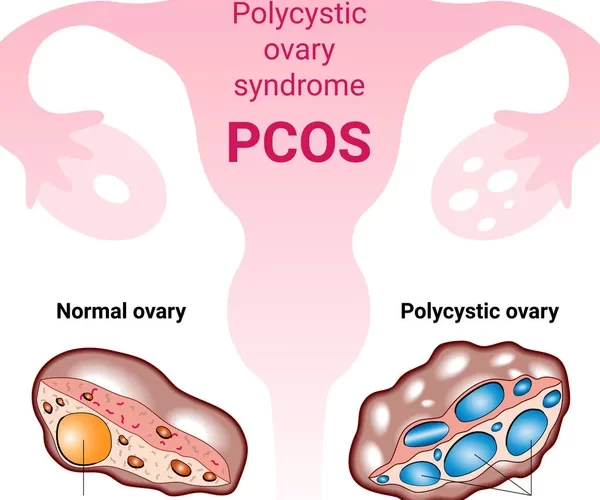 Cracking the PCOS Code: Powerful Treatments for a Manageable Condition 29 PCOS