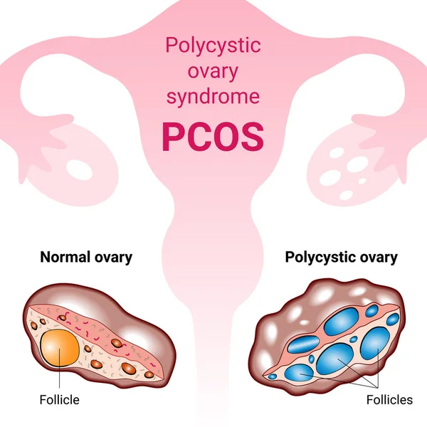 PCOS