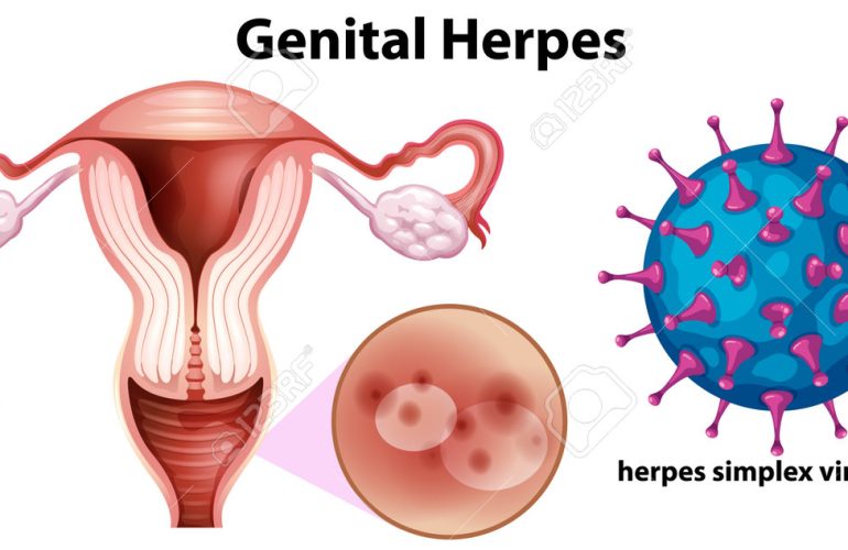 genital herpes