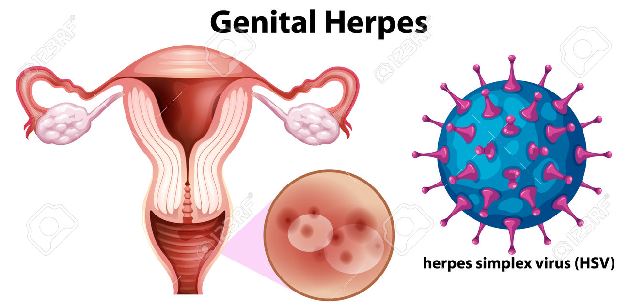 genital herpes